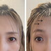 おでこのシワと目元のたるみが気になる方へ