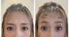 「おでこのシワと目元のたるみが気になる方へ」