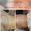 ヒゲ脱毛12回の成果！首元〜あご下のビフォーアフター
