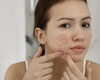 ニキビ肌改善に期待できる施術 (27文字)「くり返すあご・ほほニキビに！ツルツル肌を目指すニキビフェイシャルエステ」