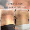 ヒゲ脱毛5回でここまで変化！首元ビフォーアフター