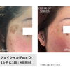 光フェイシャル4回でここまで変化♪シミケアのビフォーアフター