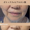 【症例：75歳女性】『ボトックス+ヒアルロン酸』