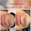 ヒゲ脱毛10回でここまで変化！口元ビフォーアフター