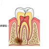 歯根破折（しこんはせつ）とは？歯の根が割れたときのお話