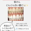 どんどん白い歯に！劇的変化のメディカルホワイトニング症例