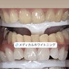 歯磨き粉では届かない白さへ！メディカルホワイトニング症例紹介