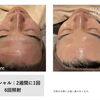 あらゆる肌トラブルに♪光フェイシャルでつるんと明るい素肌へ【脱毛サロン/メンズ脱毛/光フェイシャル/大在】