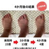 【外反母趾の症例｜4か月後の変化】