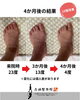 「【外反母趾の症例｜4か月後の変化】」