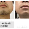 【メンズ症例】ヒゲ脱毛9回でのビフォーアフターのご紹介