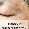 シミを隠すことから卒業しませんか？WhiteLABの経過をご紹介