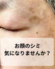 「シミを隠すことから卒業しませんか？WhiteLABの経過をご紹介」