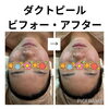 肌の調子抜群！今までで一番！ダクトピールの嬉しいご感想