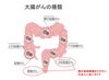 大腸がんの種類「ダウンタウン松本さんらが語った健康と家族への思い」