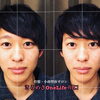 【小顔矯正ビフォーアフター⑩】