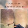 顎まわりのヒゲ脱毛ビフォーアフターをご紹介