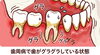 歯周病が進行して、歯がグラグラしている図「痛みが出てから治療するとどうなる？（歯周病編）」