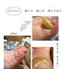 肥厚爪ケアで、歩ける喜びとキレイをみっけ！