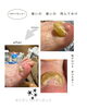 「肥厚爪ケアで、歩ける喜びとキレイをみっけ！」