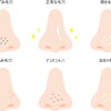 毛穴治療、結局どの施術がいいの？