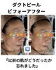 「以前の肌を忘れてしまうほどの変化！韓国ピーリング、ダクトピールでお肌アップデート！」