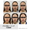 毛穴やくすみが気になる方へ♪人気メニュー「グロス肌ピーリングエステ」で特別な日に向けたツヤ肌ケア