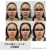 毛穴やくすみが気になる方へ♪人気メニュー「グロス肌ピーリングエステ」で特別な日に向けたツヤ肌ケア