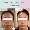 肌再生プラズマ9回のケアによる変化‪👍🏻  ̖́-