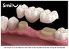 「Cầu Răng Sứ Và Implant: Nên Chọn Phương Pháp Nào? Giải Đáp Từ Smilux Dental」