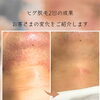 ヒゲ脱毛2回での変化をご紹介｜まずは気軽に始められる安心感を