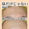 鼻だけじゃない！額の毛穴詰まりもケアできます！　美濃市、関市、郡上市、各務原市、美濃加茂市、岐阜県民でお肌悩みのある方はアベニールへ！【岐阜県美濃市、毛穴専門サロンアベニール】