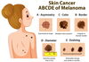 メラノーマのABCDE「ほくろは皮膚科？形成外科？」
