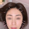 フェイスラインの悩みに寄り添う。状態に合わせて丁寧に整えるLumias式美容鍼