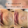 顎ヒゲ脱毛5回での見た目の変化をご紹介｜都度払いで目指す清潔感のある口元