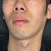 口下のヒゲだけ整えたい男性へ✨都度払い1回2,000円から始めるパーツ脱毛👌