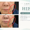 HIFUによるたるみ・フェイスライン引き締めの施術直後症例をご紹介します