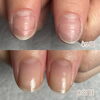 爪の凸凹や横溝にお悩みの方へ｜健やかで滑らかな指先へ育てるビフォーアフター【泉大津市】
