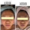 NRナインで背中から整えるお顔ケア。1回目から3回目の経過と継続の心地よさ