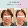 大口式小顔美整体一回の施術の変化✨