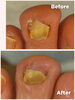 トラブル爪のBefore・After「トラブル爪は親指だけじゃない👣足トラブルに特化したフットケアサロン👣大阪駅・梅田駅から2駅🚉にある個室サロン🏡野田阪神からすぐ🚶‍➡️」
