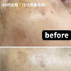 気になるシミやくすみに。前後の違いを実感する都度払いのシミケア施術