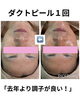 「【ダクトピール】お肌に悪環境でも1回でこんなに素晴らしい変化が！！」
