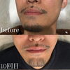 【髭脱毛20回目 Before・After】 海南市脱毛