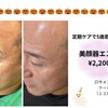 美顔器エステ