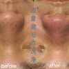 超音波毛穴洗浄のBefore・After✨ 毛穴汚れをすっきり整えて滑らかな素肌へ🌿 海南市エステサロン