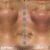 超音波毛穴洗浄のBefore・After✨ 毛穴汚れをすっきり整えて滑らかな素肌へ🌿 海南市エステサロン