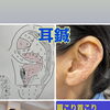 耳介画像鍼　鍼灸師による耳はり