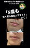 「ヒゲ脱毛」