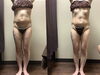 脂肪冷却「40代 女性　お腹の脂肪・ぽっこりお腹」
